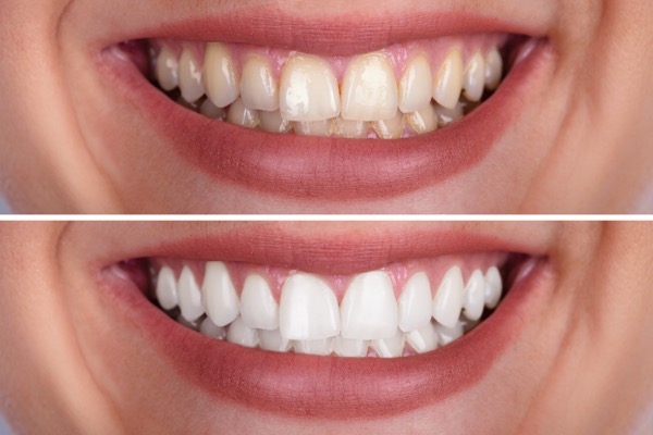 Clareamento dental em Cabo Frio