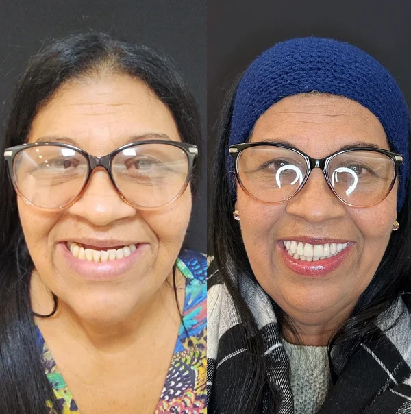 Antes e depois de implante dentário