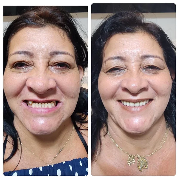 Antes e depois de implante dentário