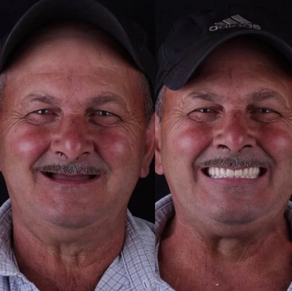 Seu Antônio, antes e depois do implante dentário