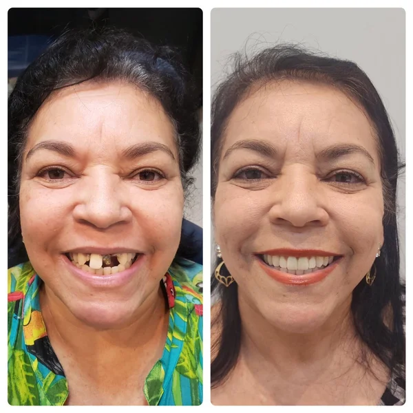 Dona Neide, antes e depois do implante dentário