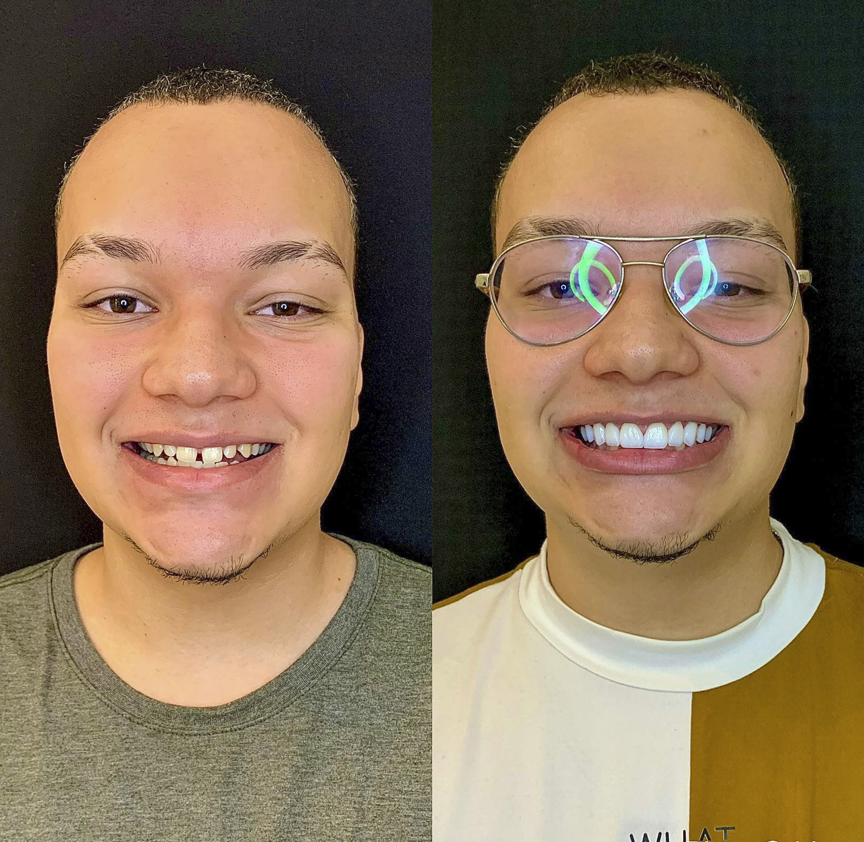 Antes e depois de lentes de contato dental