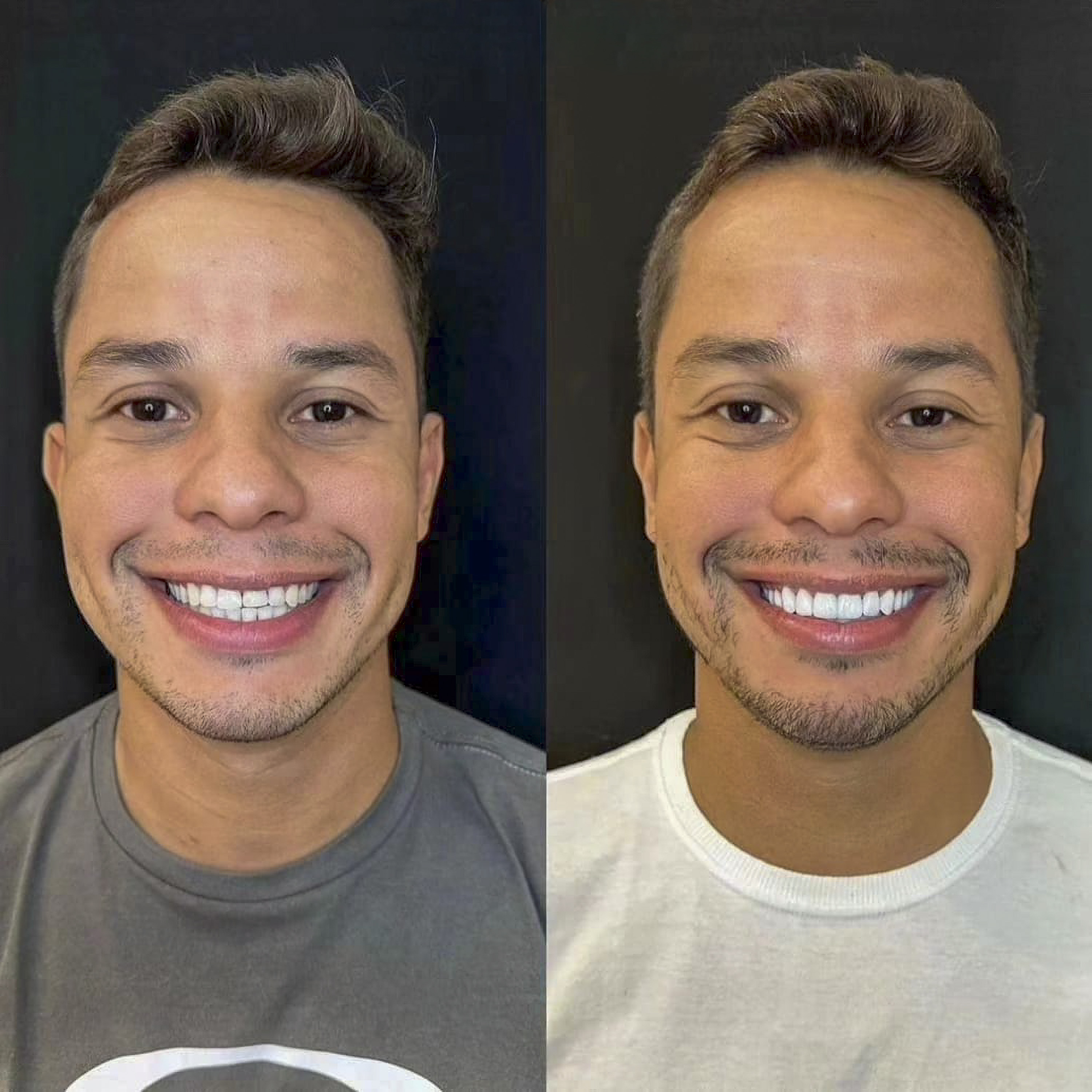 Antes e depois de lentes de contato dental