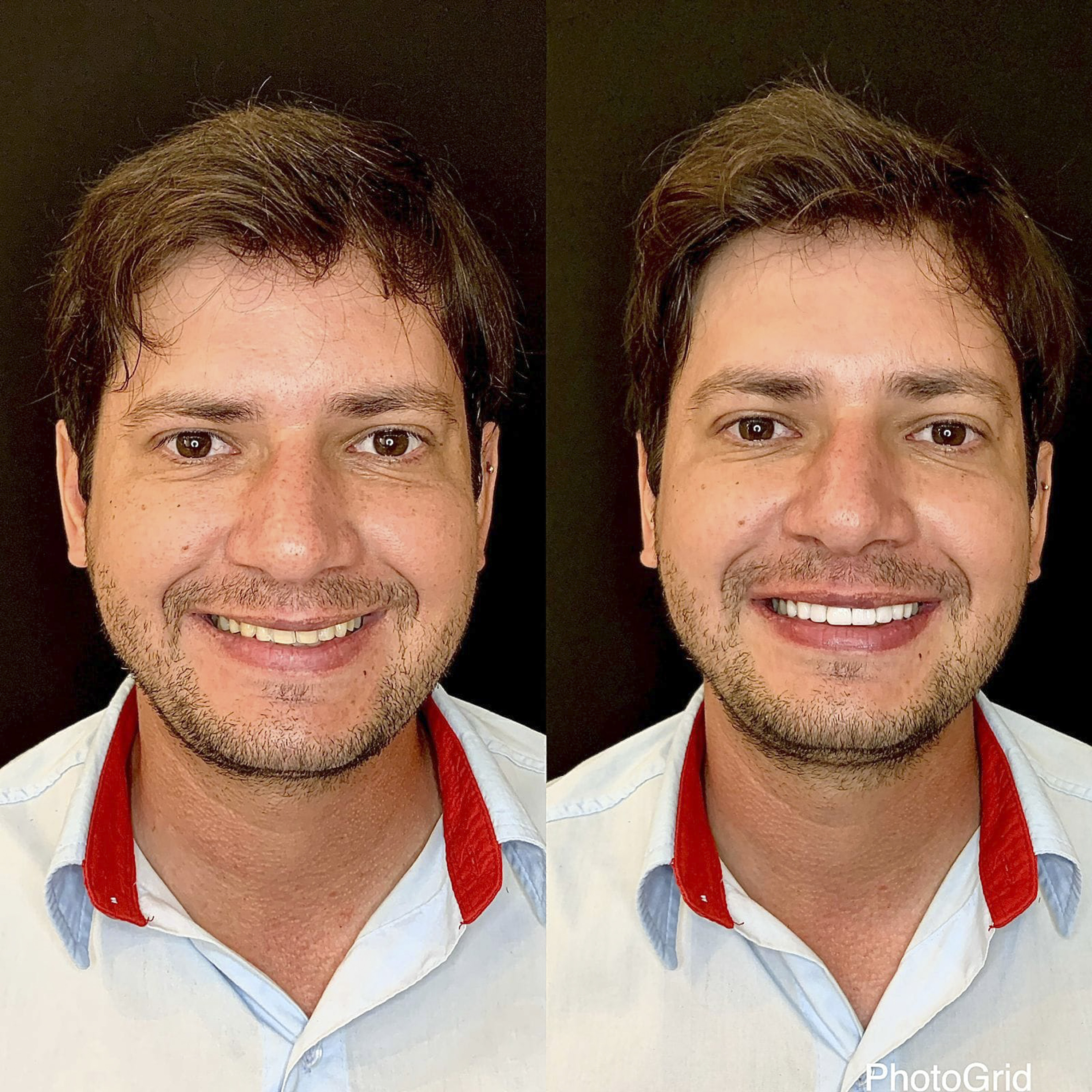 Antes e depois de lentes de contato dental