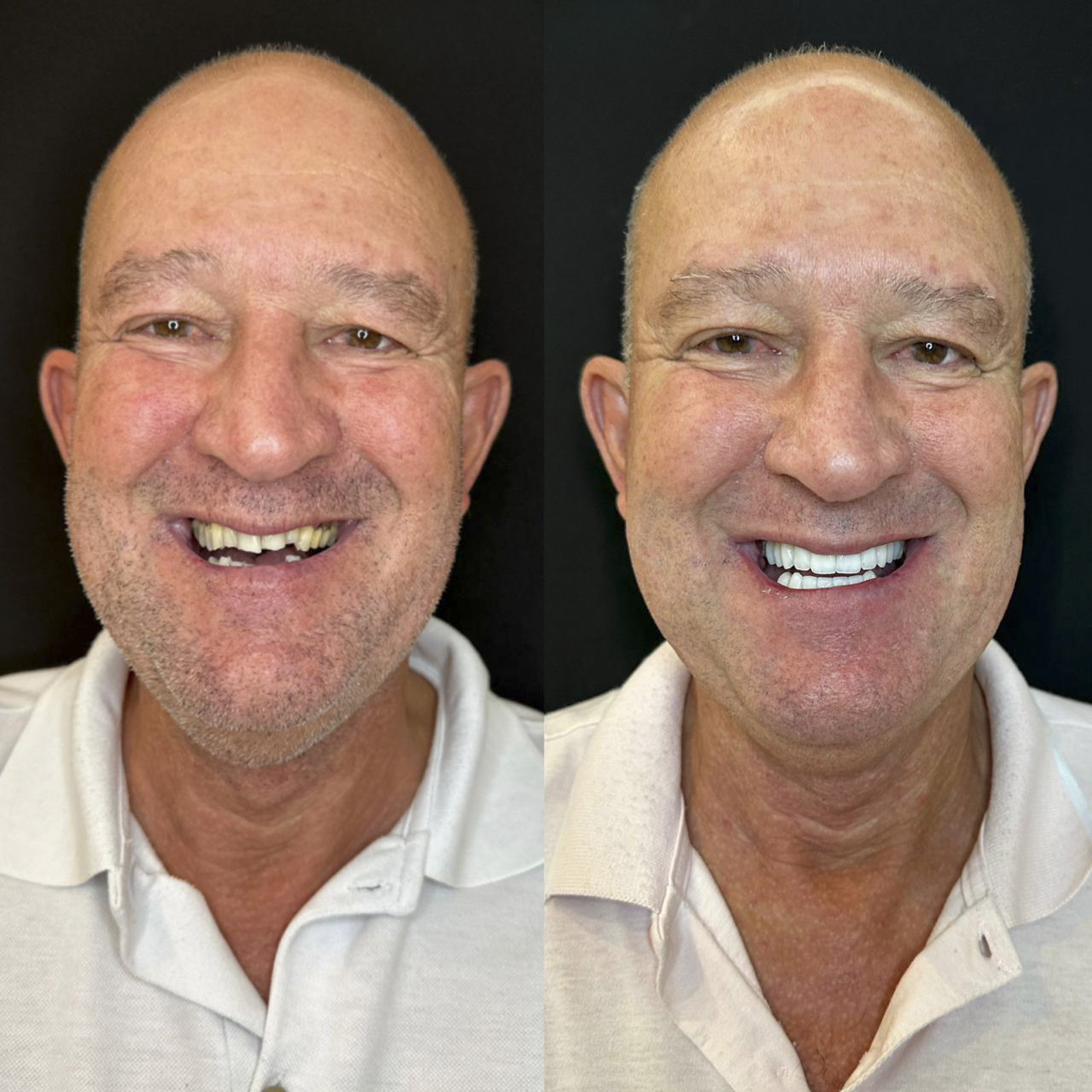 Antes e depois de lentes de contato dental