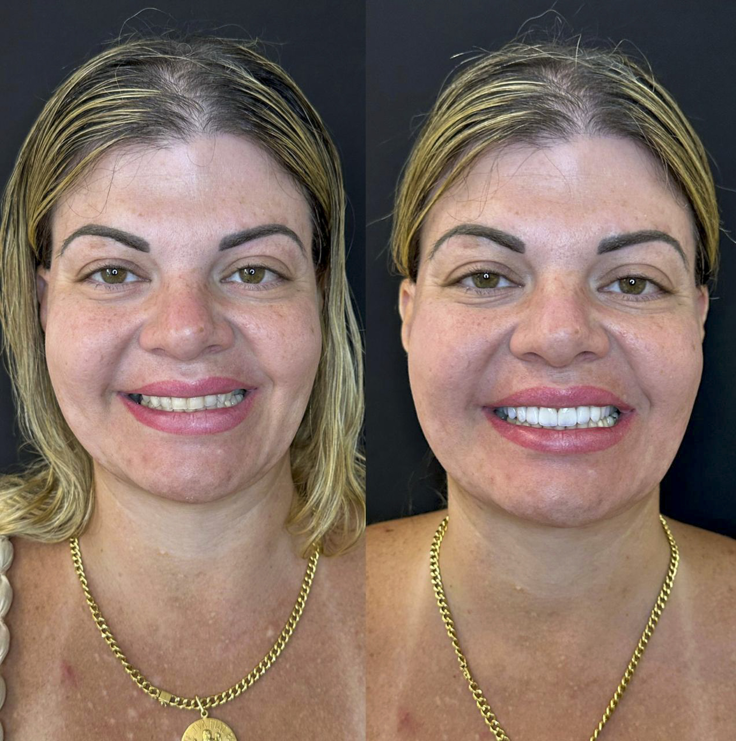Sandra, antes e depois das lentes de contato dental